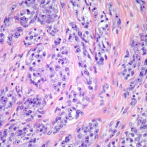 Clear cell sarcoma.Image12.jpg