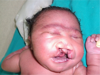 Capillary hemangioma, bilateral cleft, and palate.