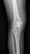 Chondrosarcoma (Radiopaedia 23076).jpg