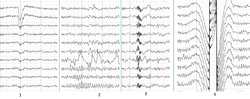 Main types of artifacts in human EEG