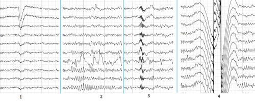Main types of artifacts in human EEG