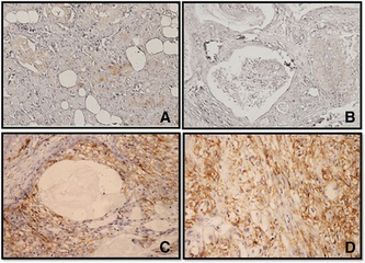 a-d)Immunohistochemistry for CD44 in Mucoepidermoid carcinomas