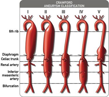 The Crawford Classification (Extent I-IV) and the Safi modification (Extent V) for thoracoabdominal aortic aneurysms is pictured above.
