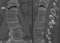 The intravertebral vacuum cleft sign (at white arrow) is a sign of avascular necrosis. Avascular necrosis of a vertebral body after a vertebral compression fracture is called Kümmel's disease.[20]