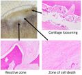 Pathology of avascular necrosis, with a photograph of a cross-section of the involved bone at top left. The reactive zone shows irregular trebaculae with empty lacunae, and fibrosis of the marrow space.