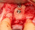 Bone taken from another site (commonly the back of the bottom jaw) can transplanted in the same person to the implant site when a greater amount of bone is needed.