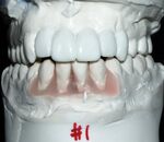 Sometimes the final position and restoration of the teeth will be simulated on plaster models to help determine the number and position of implants needed.