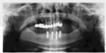 Panorex radiograph showing implants