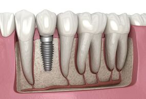 Dental Implant