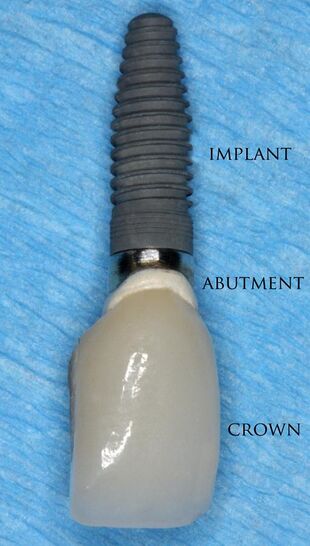 Single crown implant.jpg