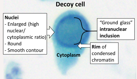 Cytology of a polyomavirus infected cell, using Papanicolaou stain. The high nuclear to cytoplasmic ratio makes it resemble cancer (thus the name "decoy cell") but the inclusion body reveals its viral pathophysiology.