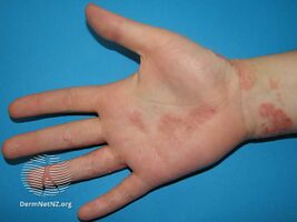 Hand eczema