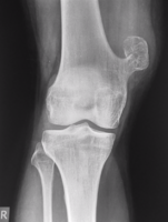 Osteochondroma[1]