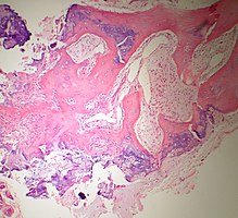 Bone Bizzare Parosteal Osteochondromatous Proliferation