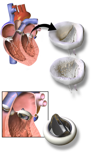 Blausen 0057 ArtificialHeartValve StFrancis.png