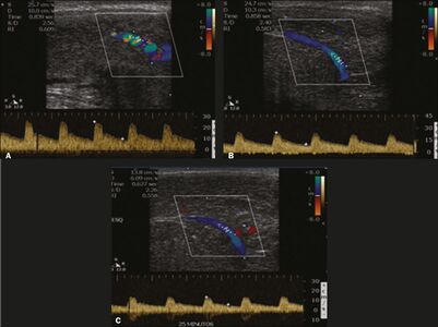 Longitudinal, ventral ultrasound of the penis, with pulsed mode and color Doppler. Flow of the cavernous arteries at 5, 15, and 25 min after prostaglandin injection (A, B, and C, respectively). The cavernous artery flow remains below the expected levels (at least 25–35 cm/s), which indicates ED due to arterial insufficiency.[23]