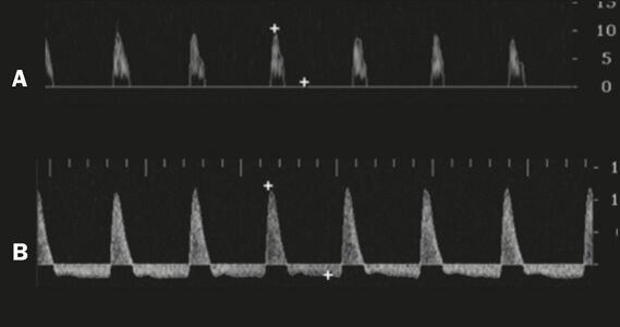 Graphs representing the color Doppler spectrum of the flow pattern of the cavernous arteries during the erection phases. A: Single-phase flow with minimal or absent diastole when the penis is flaccid. B: Increased systolic flow and reverse diastole 25 min after injection of prostaglandin.[23]