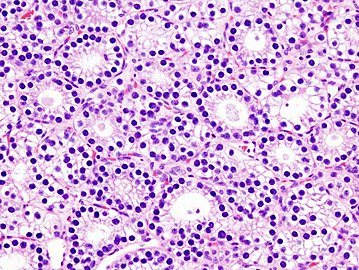 Histopatholgical image of parathyroid adenoma in a patient with primary hyperparathyroidism. Hematoxylin and eosin stain. Another view of the same lesion