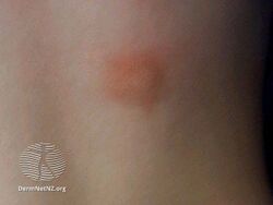 Urticaria pigmentosa