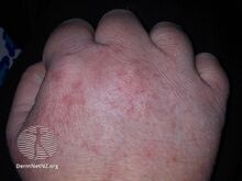 Hand dermatitis in a patient with COVID-19 infection