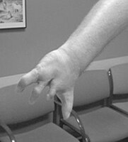 Right hand symbrachydactyly in Poland syndrome[2]
