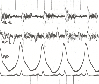 Phonocardiogram and jugular venous pulse tracing from a middle-aged man with pulmonary hypertension caused by cardiomyopathy. The jugular venous pulse tracing demonstrates a prominent a wave without a c or v wave being observed. The phonocardiograms (fourth left interspace and cardiac apex) show a murmur of tricuspid insufficiency and ventricular and atrial gallops.