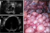 Endosalpingiosis1.png