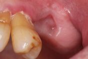 clinical photograph of a well healed socket