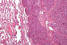 Micrograph of a metastatic Ewing sarcoma with the characteristic cytoplasmic clearing on H&E staining, which was showing to be PAS positive