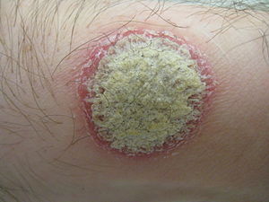 Psoriasis2010.JPG