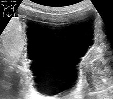 Ultrasonography showing a trabeculated wall, seen as small irregularities mainly at left (superior part). This is strongly associated with urinary retention.[6]