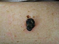 Photography of nodular melanoma.jpg