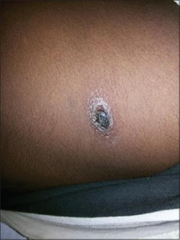 Eschar in chest wall