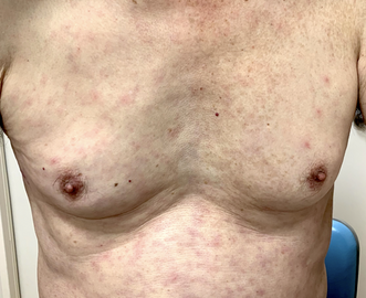 Macular eruption with some scattered papules on his trunk