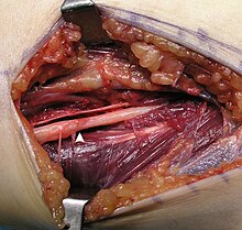 Operating field after removal of the lipoma: Arrow marks the median nerve that was compressed by the lipoma.