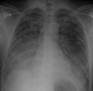 Chest Xray 40 yr old male acute respiratory distress syndrome as a complication of murine typhus. 13-1421-F1.jpg