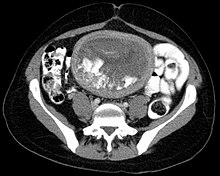 Hydatidiform mole on CT, axial view