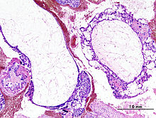 Histopathologic image of hydatidiform mole (complete type). H & E stain.