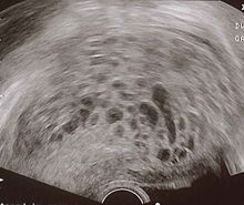 Transvaginal ultrasonography showing a molar pregnancy.