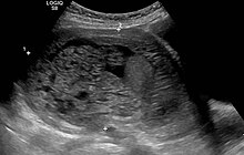 Molar pregnancy in ultrasound