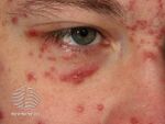 Acne agminata around eyelid (DermNet NZ site-age-specific-s-eyelid-29).jpg