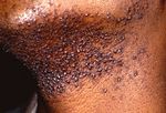 Pseudofolliculitis Barbae.jpg