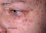 Pustules due to potassium iodide (DermNet NZ treatments-s-pot-iodide).jpg