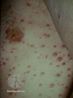 Secondary syphilis (DermNet NZ bacterial-syph8).jpg