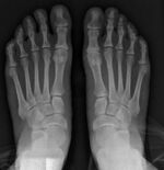 2_years_after_syndesmosis_surgery