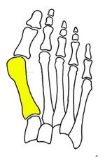 First metatarsal bone has moved aside