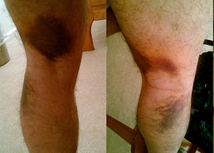 2010-10-02 pulled hamstring.jpg