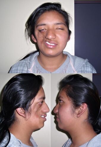 Parry Romberg Syndrome 1.jpg