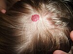 Hemangioma.JPG