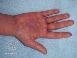 Morbilliform eruption